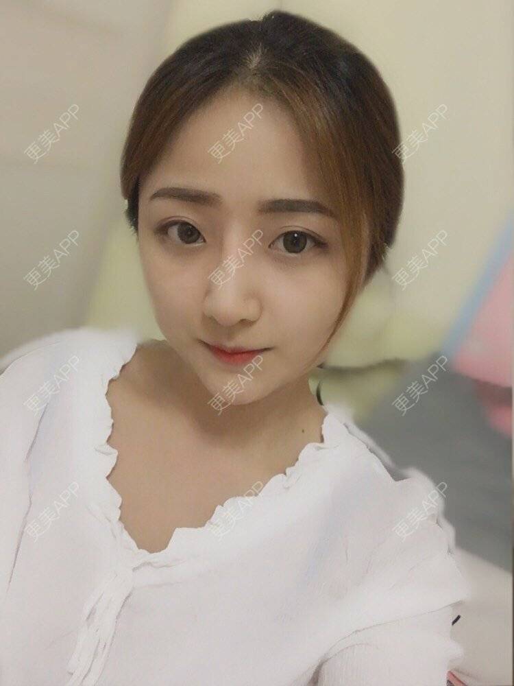 更美 - 更美用户qmLmUIMryz的肋软骨隆鼻经验 | 肋软骨隆鼻 | 南阳