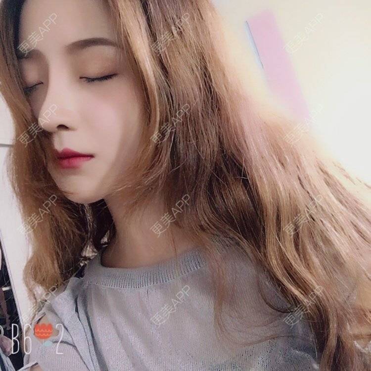 更美 - 更美用户qmLmUIMryz的肋软骨隆鼻经验 | 肋软骨隆鼻 | 南阳