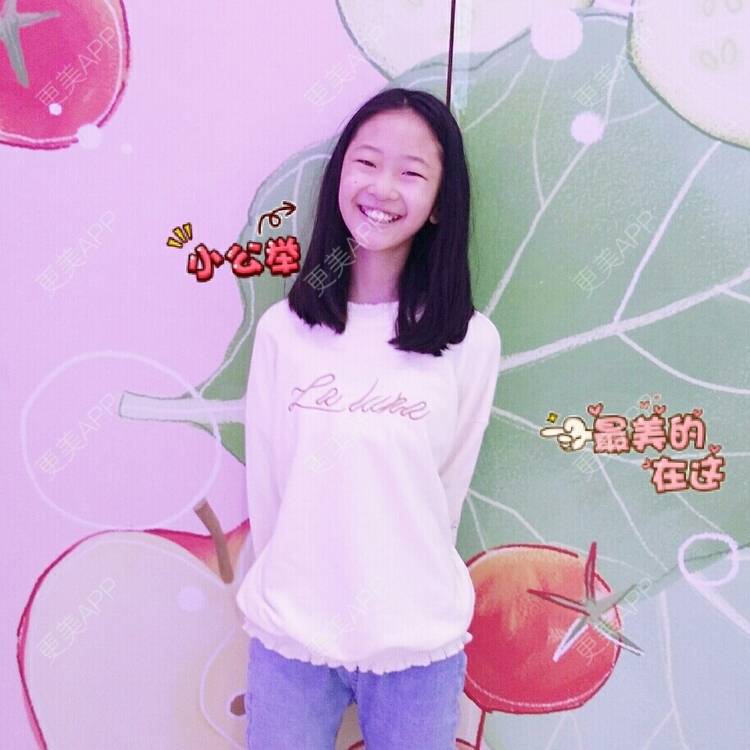 更美 - 小仙女冰草的双眼皮修复经验 | 双眼皮修复 | 鼻小柱延长 | 角膜屈光手术