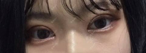 更美 - 更美用户4vWkxGPMVV的全切双眼皮经验 | 上眼睑去脂 | 全切双眼皮 | 武汉
