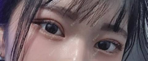 更美 - 更美用户4vWkxGPMVV的全切双眼皮经验 | 上眼睑去脂 | 全切双眼皮 | 武汉