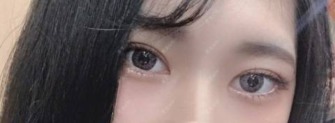 更美 - 更美用户4vWkxGPMVV的全切双眼皮经验 | 上眼睑去脂 | 全切双眼皮 | 武汉