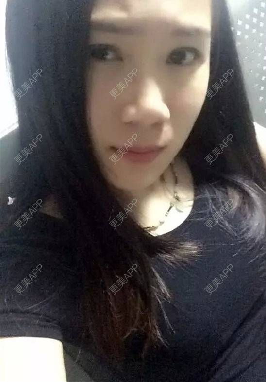 更美 - MOLI_默默的假体隆胸经验 | 假体隆胸 | 南昌