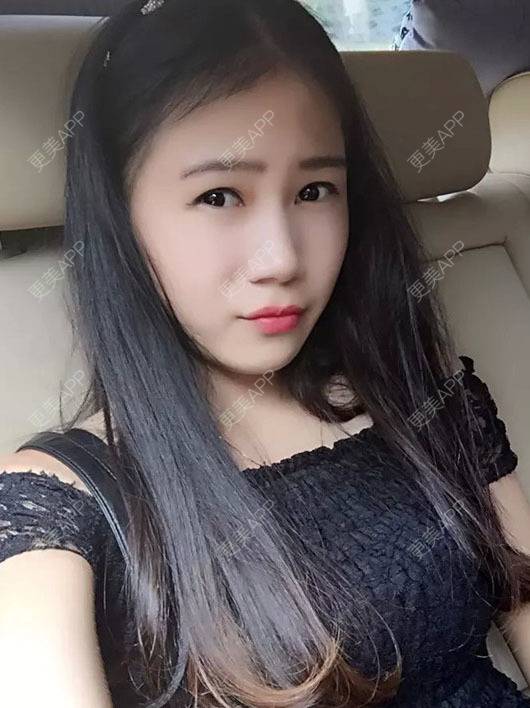更美 - MOLI_默默的假体隆胸经验 | 假体隆胸 | 南昌