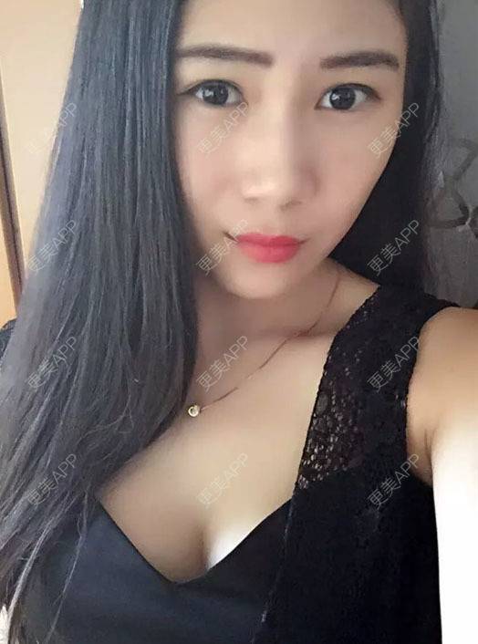 更美 - MOLI_默默的假体隆胸经验 | 假体隆胸 | 南昌