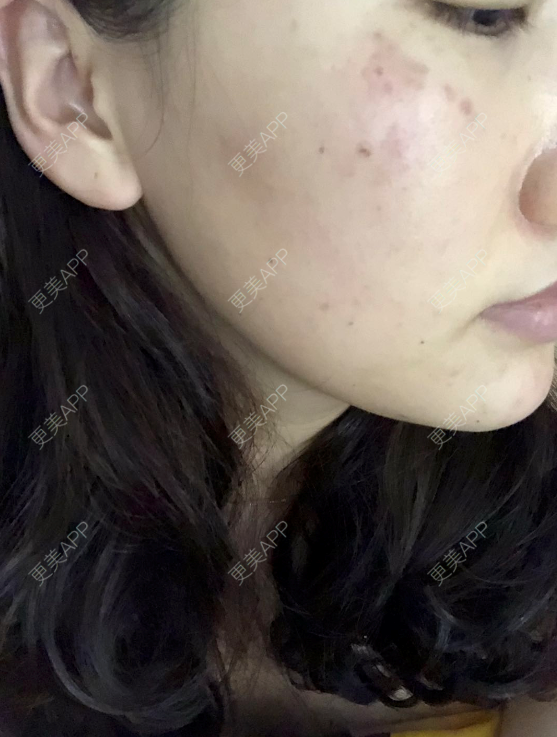背上黑色痘印怎么消除（黑色痘印怎么消除）-第2张图片-潮百科