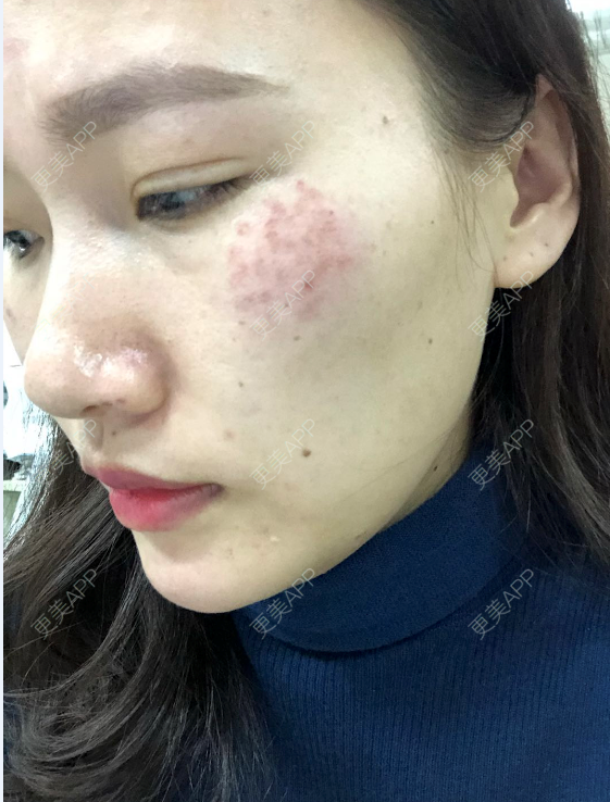 激光祛斑】picoway超皮秒全模式,想祛斑雀斑/真皮斑/晒斑 嫩肤/美白去