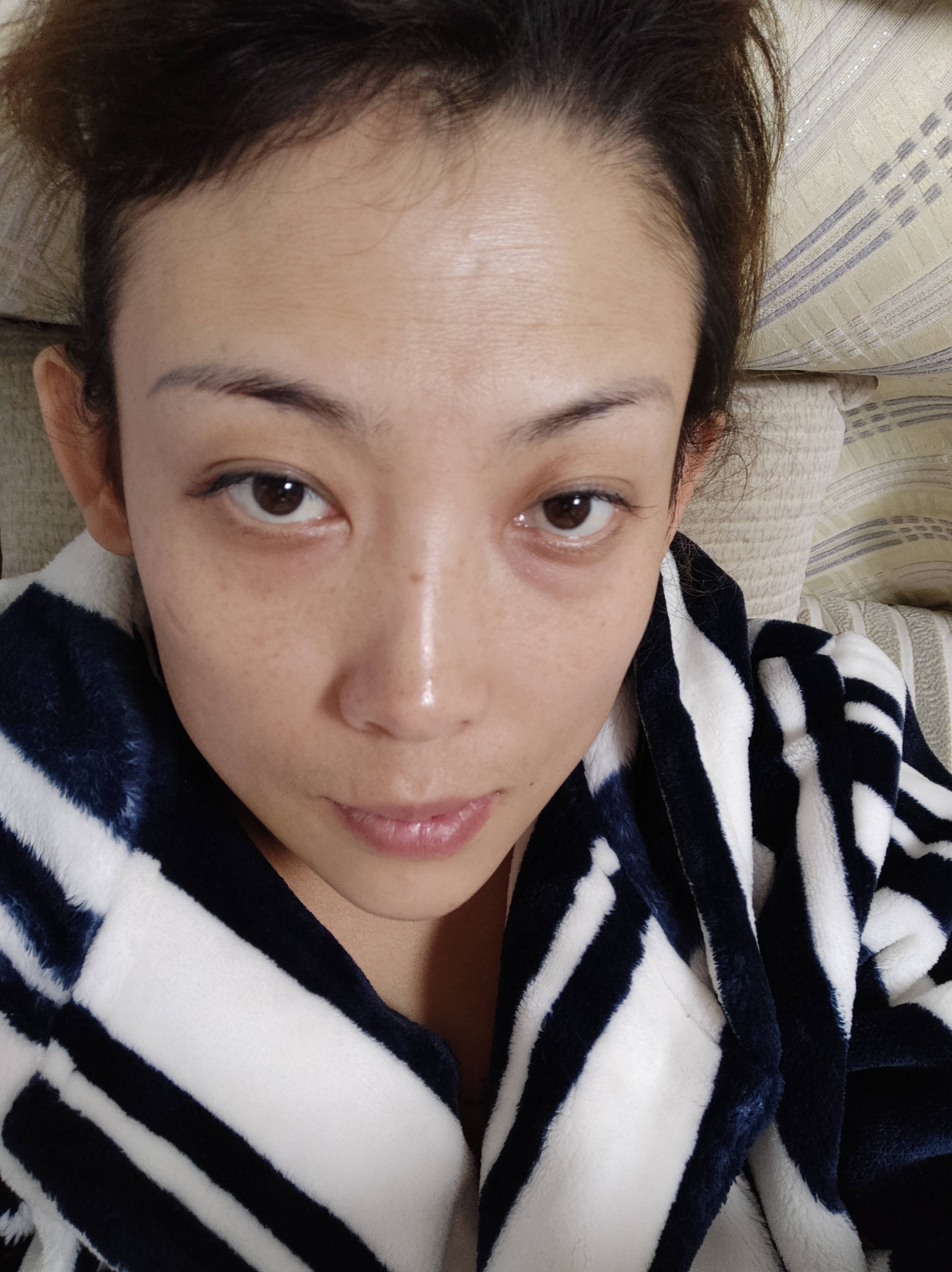 保定蓝山刘海涛是眼科医生吗?注射瘦脸?注射瘦脸术后三个月真实野生反馈