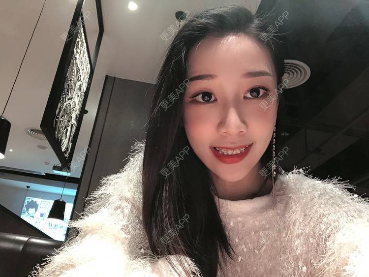 更美 - －Ｊane.’的牙齿矫正经验 | 牙齿矫正 | 广州