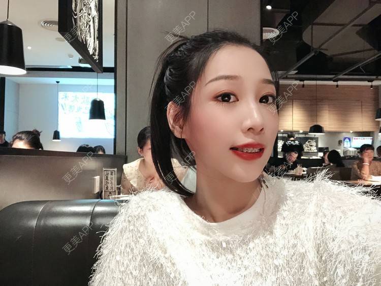 更美 - －Ｊane.’的牙齿矫正经验 | 牙齿矫正 | 广州