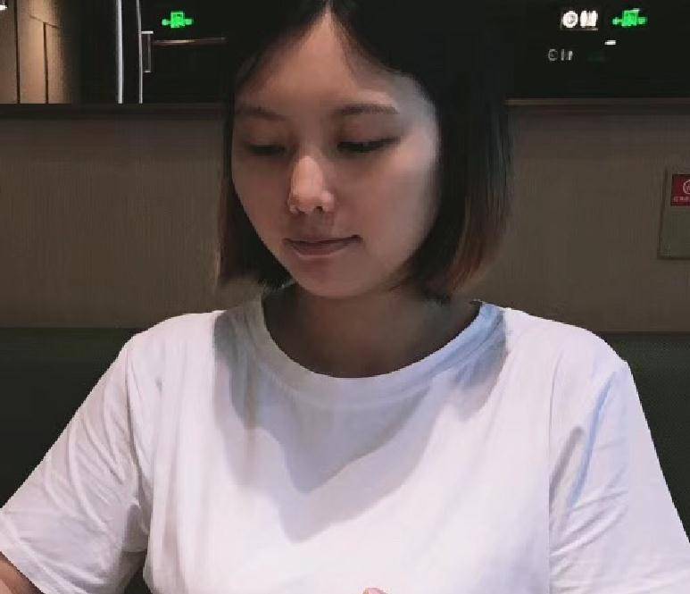 北大崔永言双眼皮做得怎么样?镭射净肤案例-价格表一起展出