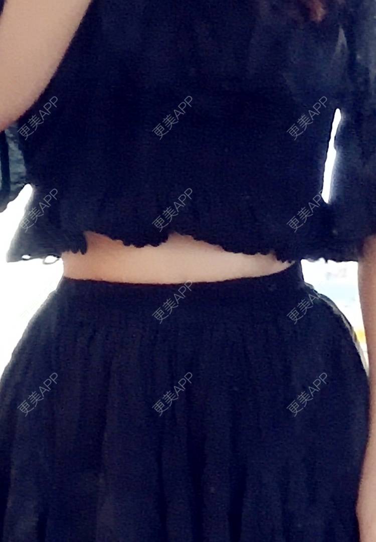 更美用户gsav4k1qxg的腰腹吸脂日记