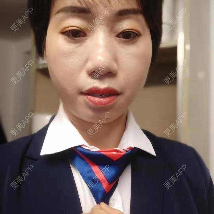 更美 - 踢毽子的小女孩2的外切去眼袋经验 | 外切去眼袋 | 广州