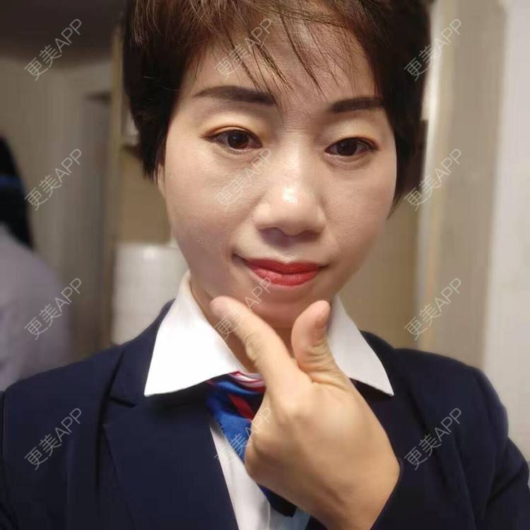 更美 - 踢毽子的小女孩2的外切去眼袋经验 | 外切去眼袋 | 广州