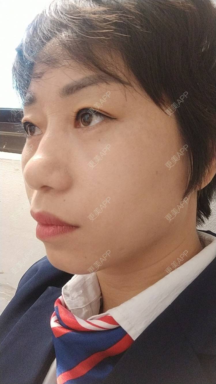 更美 - 踢毽子的小女孩2的外切去眼袋经验 | 外切去眼袋 | 广州