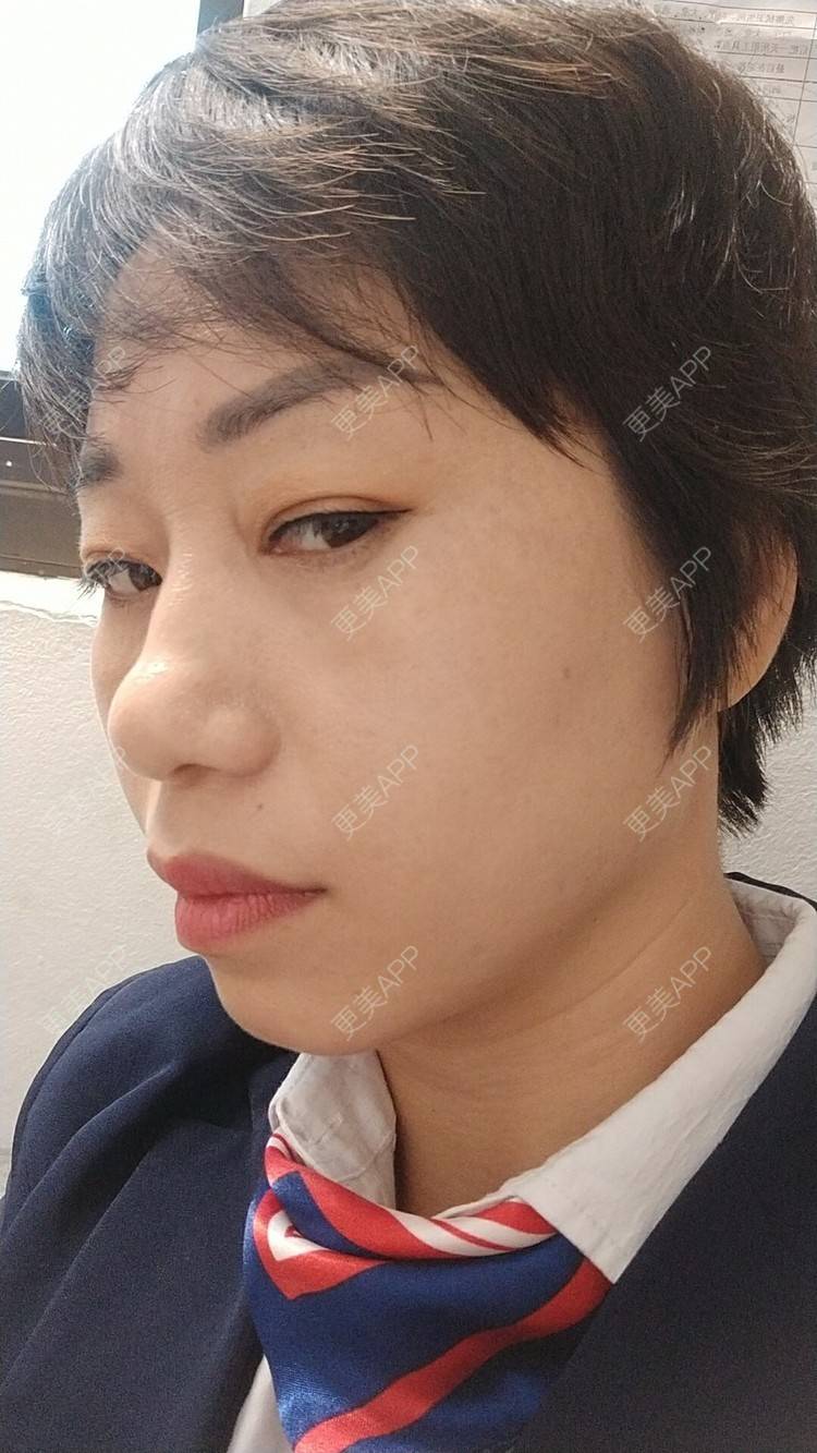 更美 - 踢毽子的小女孩2的外切去眼袋经验 | 外切去眼袋 | 广州