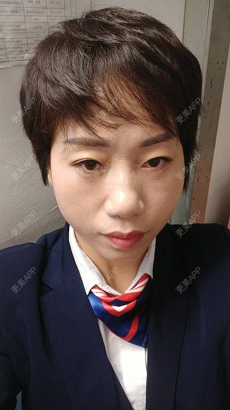 更美 - 踢毽子的小女孩2的外切去眼袋经验 | 外切去眼袋 | 广州