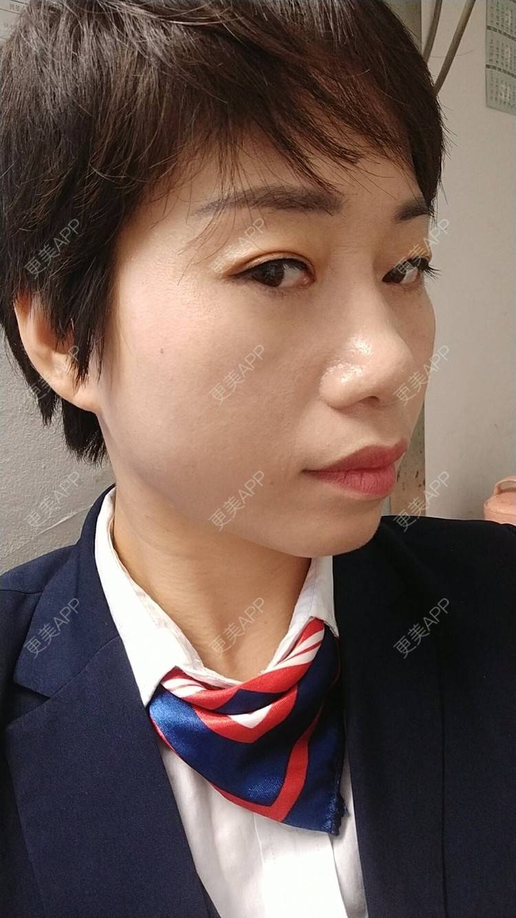 更美 - 踢毽子的小女孩2的外切去眼袋经验 | 外切去眼袋 | 广州