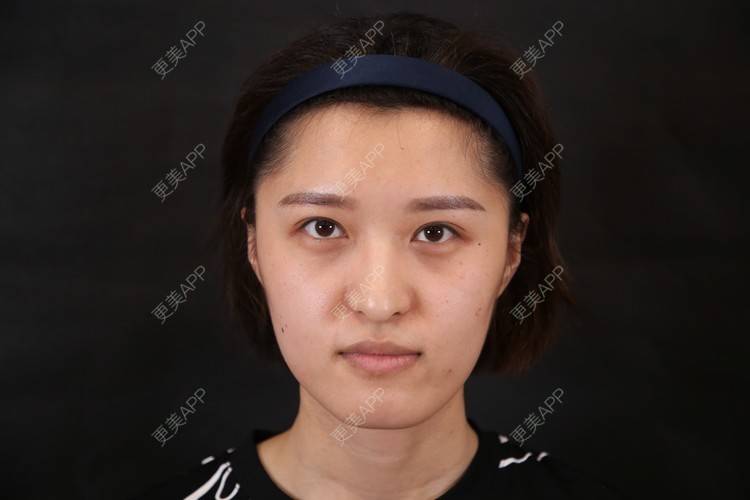 更美 - 杭州薇琳医疗美容医院的鼻部多项经验 | 鼻部多项 | 杭州