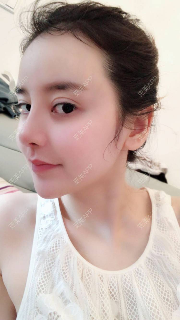 更美用户jzbajsbxp6的鼻综合日记