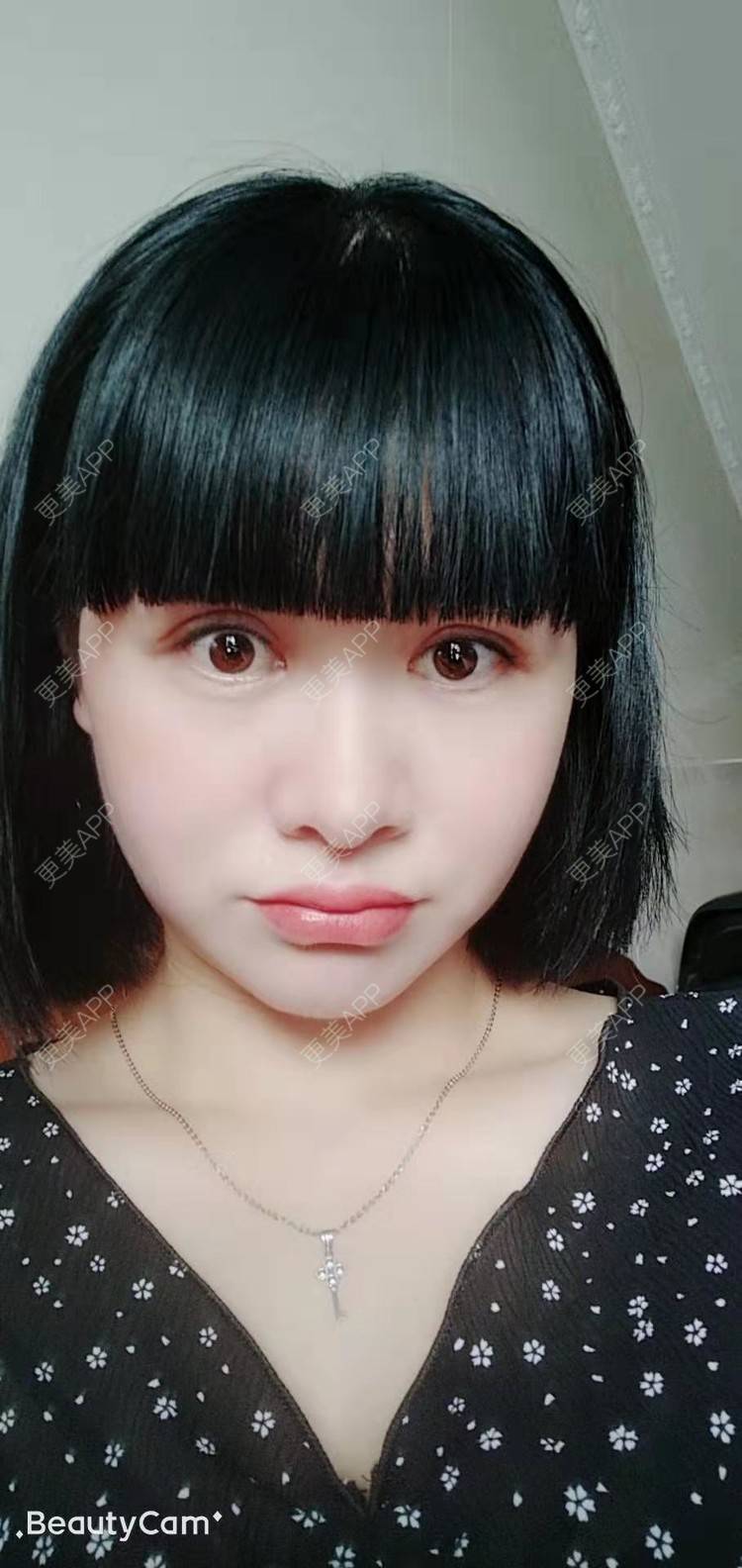 更美 - 更美用户ACmBeQHmk9的拉皮经验 | 深圳 | 拉皮