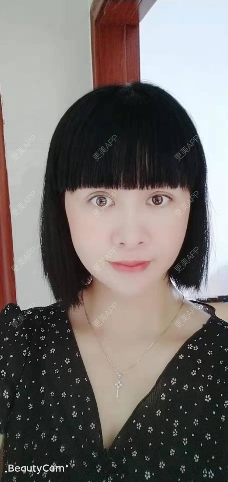 更美 - 更美用户ACmBeQHmk9的拉皮经验 | 深圳 | 拉皮