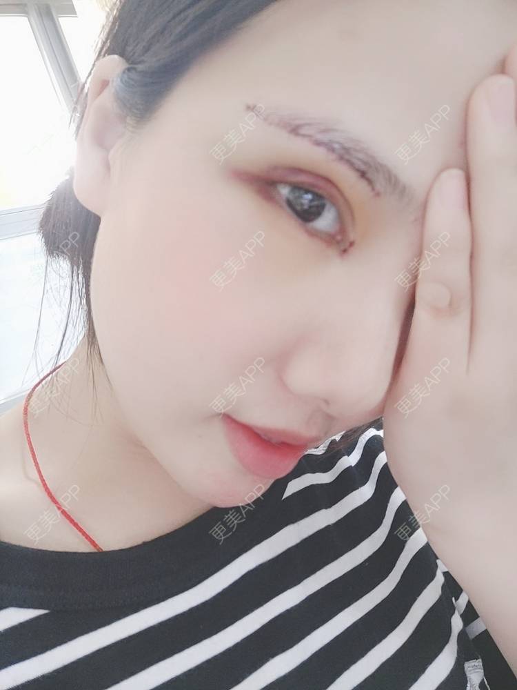更美 - 更美用户R2vuT1w108的双眼皮修复经验 | 双眼皮修复 | 广州