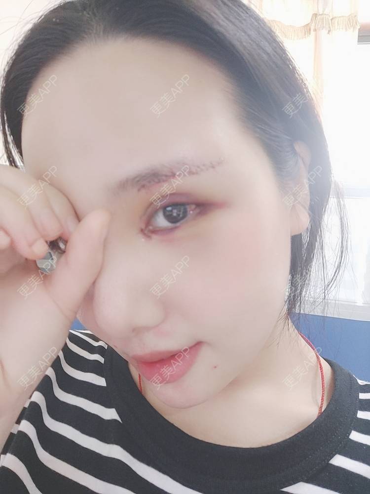 更美 - 更美用户R2vuT1w108的双眼皮修复经验 | 双眼皮修复 | 广州