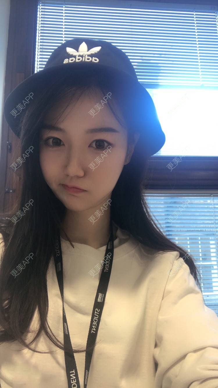 更美 - 娟娟呀的自体脂肪填充泪沟经验 | 自体脂肪面部填充 | 自体脂肪全面部填充 | 自体脂肪填充泪沟 | 自体脂肪丰苹果肌 | 自体脂肪丰面颊 | 视频日记 | 武汉