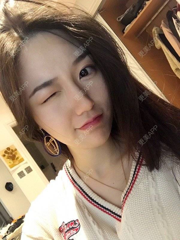 更美 - 娟娟呀的自体脂肪填充泪沟经验 | 自体脂肪面部填充 | 自体脂肪全面部填充 | 自体脂肪填充泪沟 | 自体脂肪丰苹果肌 | 自体脂肪丰面颊 | 视频日记 | 武汉