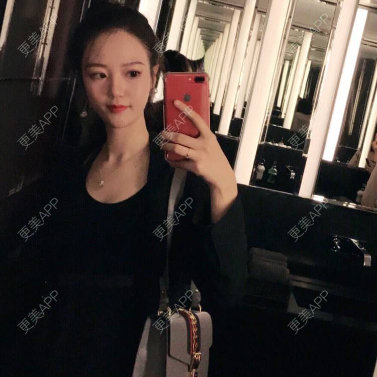 更美 - 娟娟呀的自体脂肪填充泪沟经验 | 自体脂肪面部填充 | 自体脂肪全面部填充 | 自体脂肪填充泪沟 | 自体脂肪丰苹果肌 | 自体脂肪丰面颊 | 视频日记 | 武汉