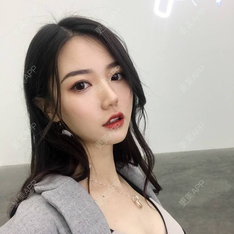更美 - 娟娟呀的自体脂肪填充泪沟经验 | 自体脂肪面部填充 | 自体脂肪全面部填充 | 自体脂肪填充泪沟 | 自体脂肪丰苹果肌 | 自体脂肪丰面颊 | 视频日记 | 武汉