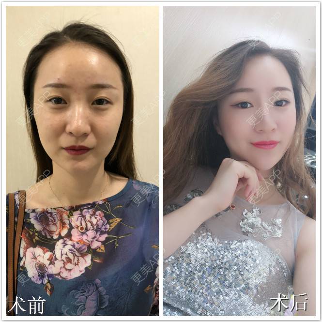 更美 - 贺建平 医生的热玛吉经验 | 热玛吉