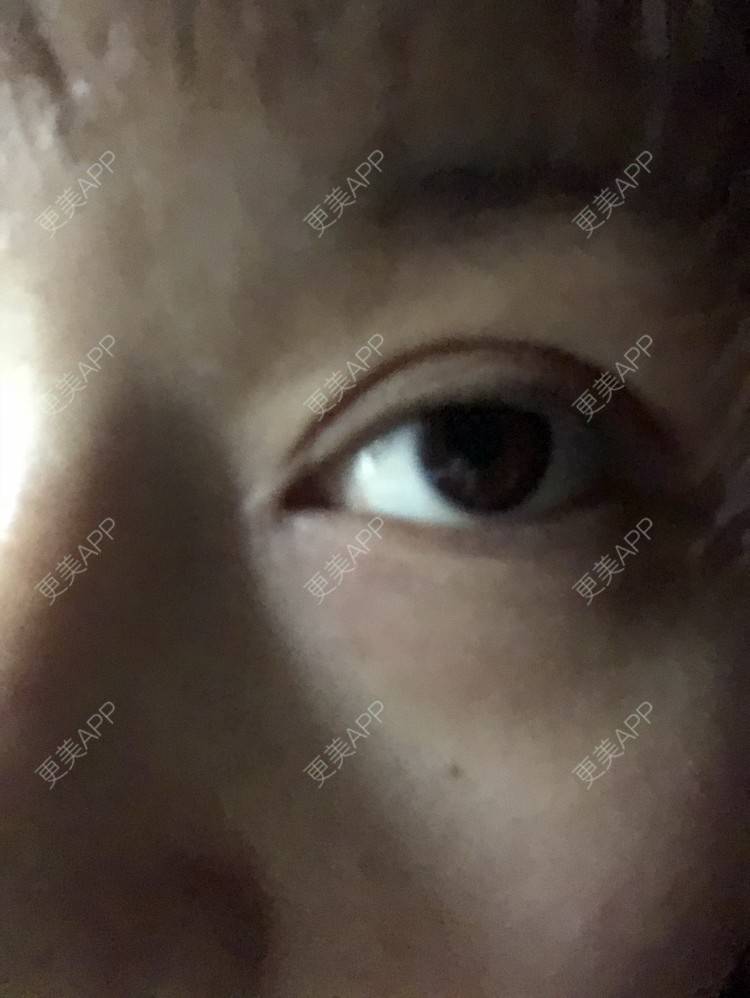 更美 - 更美用户cEwjt4J4iQ的双眼皮经验 | 双眼皮 | 盐城