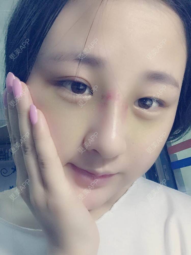 更美 - 怎么能没有炸鸡和啤酒的鼻部多项经验 | 隆鼻 | 鼻部多项 | 膨体隆鼻 | 驼峰鼻矫正 | 重庆