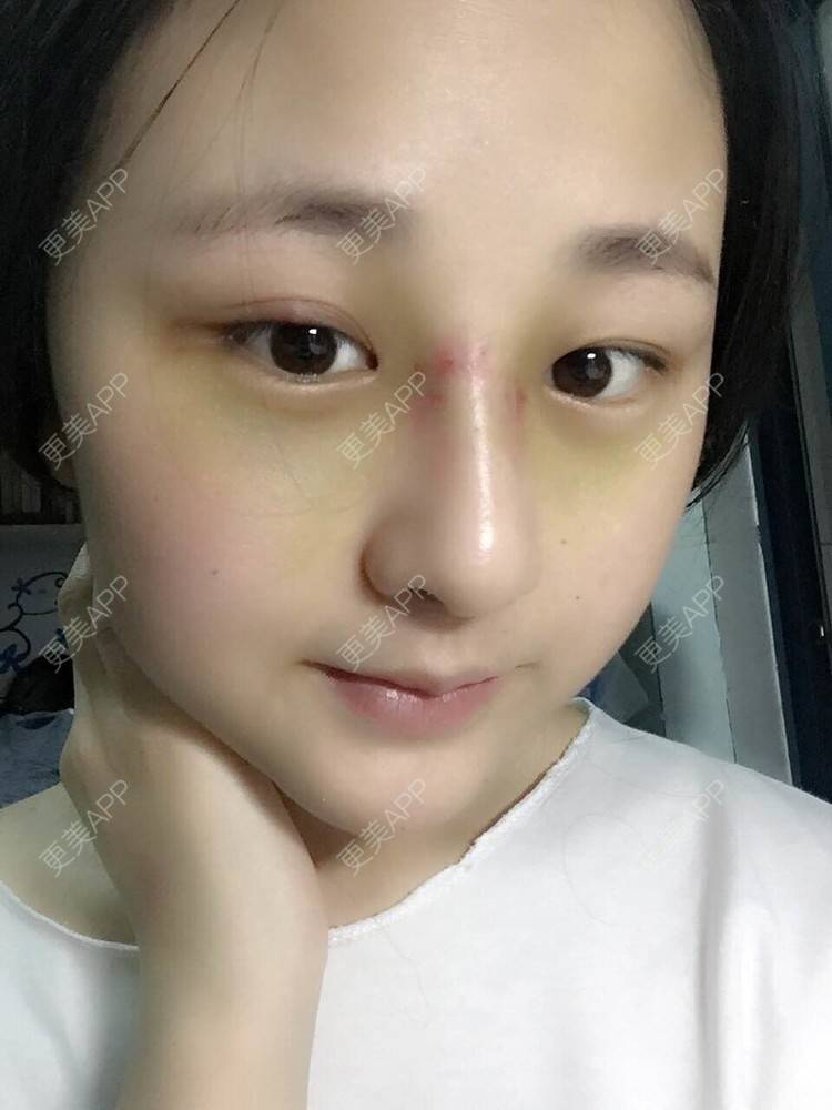 更美 - 怎么能没有炸鸡和啤酒的鼻部多项经验 | 隆鼻 | 鼻部多项 | 膨体隆鼻 | 驼峰鼻矫正 | 重庆