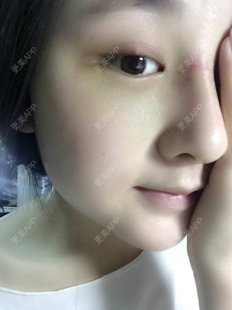 更美 - 怎么能没有炸鸡和啤酒的鼻部多项经验 | 隆鼻 | 鼻部多项 | 膨体隆鼻 | 驼峰鼻矫正 | 重庆