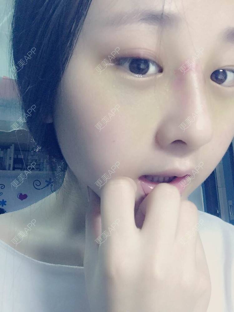 更美 - 怎么能没有炸鸡和啤酒的鼻部多项经验 | 隆鼻 | 鼻部多项 | 膨体隆鼻 | 驼峰鼻矫正 | 重庆