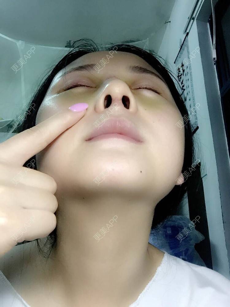 更美 - 怎么能没有炸鸡和啤酒的鼻部多项经验 | 隆鼻 | 鼻部多项 | 膨体隆鼻 | 驼峰鼻矫正 | 重庆