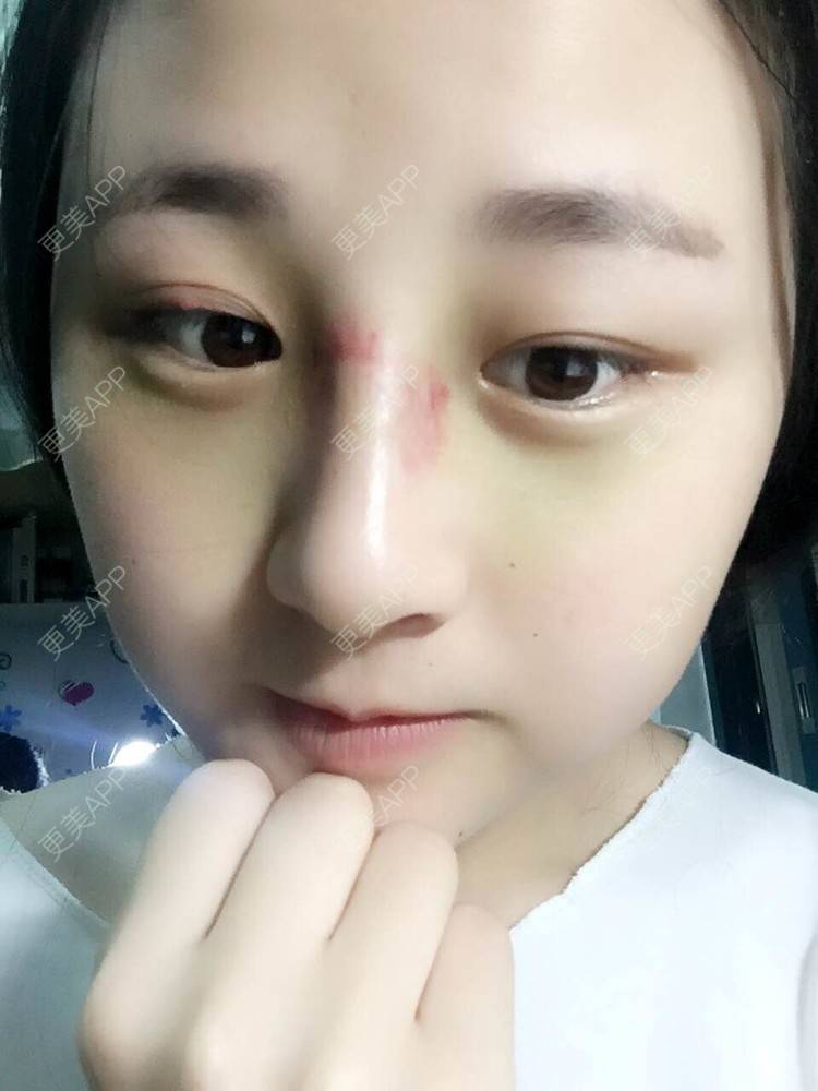 更美 - 怎么能没有炸鸡和啤酒的鼻部多项经验 | 隆鼻 | 鼻部多项 | 膨体隆鼻 | 驼峰鼻矫正 | 重庆