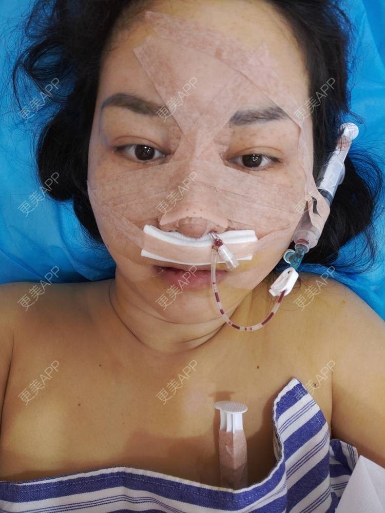 更美 - 更美用户UIAMlbTEr2的隆鼻经验 | 隆鼻