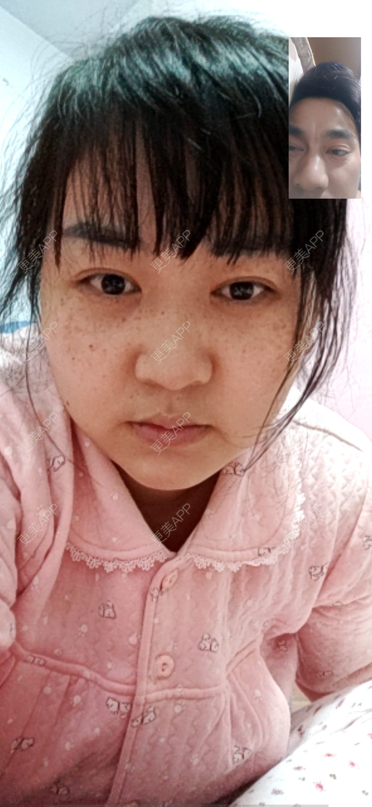 更美 - 更美用户UIAMlbTEr2的隆鼻经验 | 隆鼻