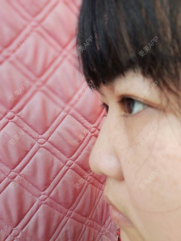 更美 - 更美用户UIAMlbTEr2的隆鼻经验 | 隆鼻