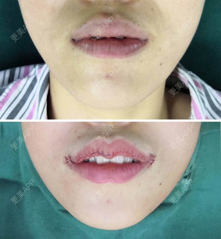 更美用户mgrnwg59jt的m唇成形术日记