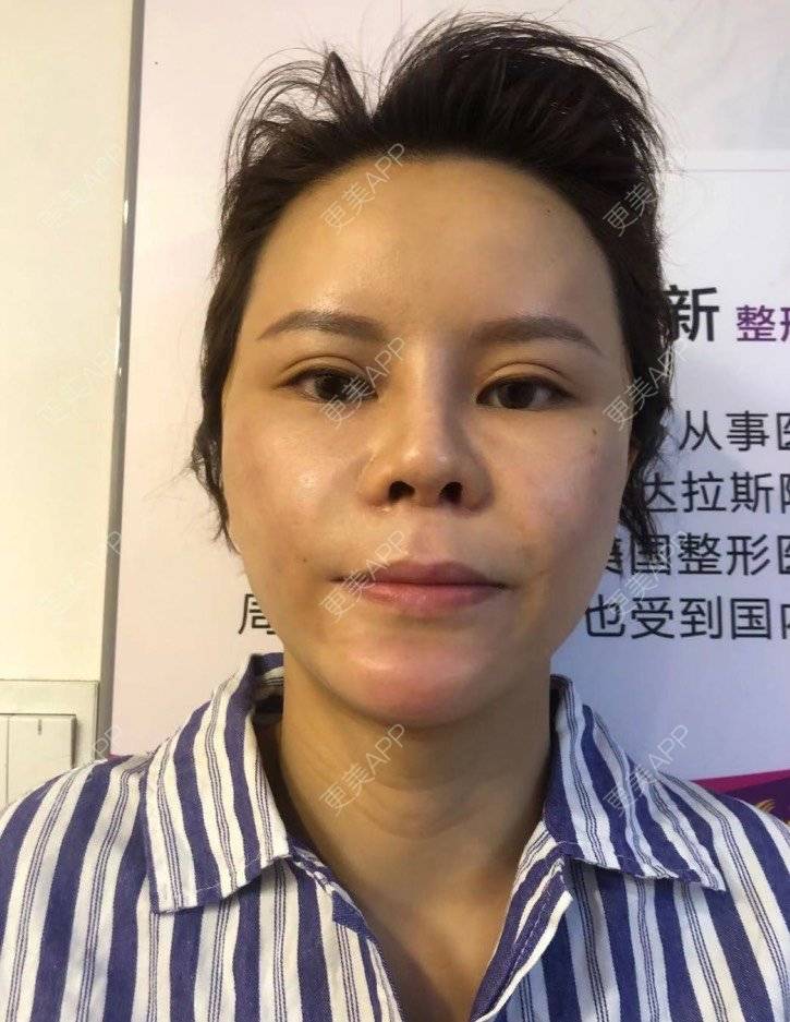 更美 - 更美用户LWa8J5Ngtz的埋线提升经验 | 深圳 | 埋线提升