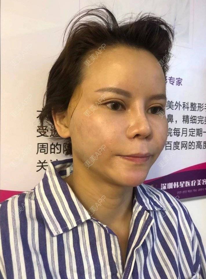 更美 - 更美用户LWa8J5Ngtz的埋线提升经验 | 深圳 | 埋线提升