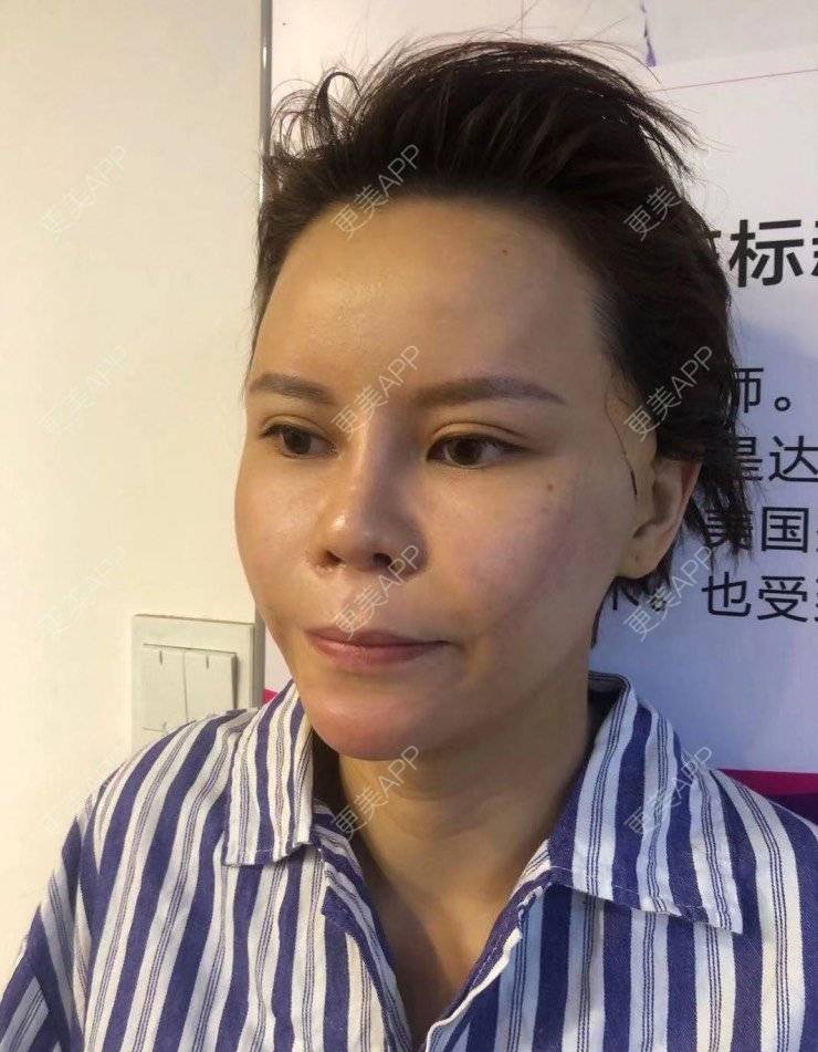 更美 - 更美用户LWa8J5Ngtz的埋线提升经验 | 深圳 | 埋线提升