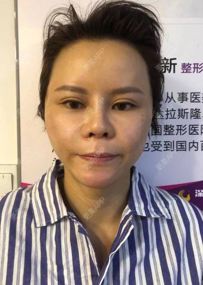 更美 - 更美用户LWa8J5Ngtz的埋线提升经验 | 深圳 | 埋线提升