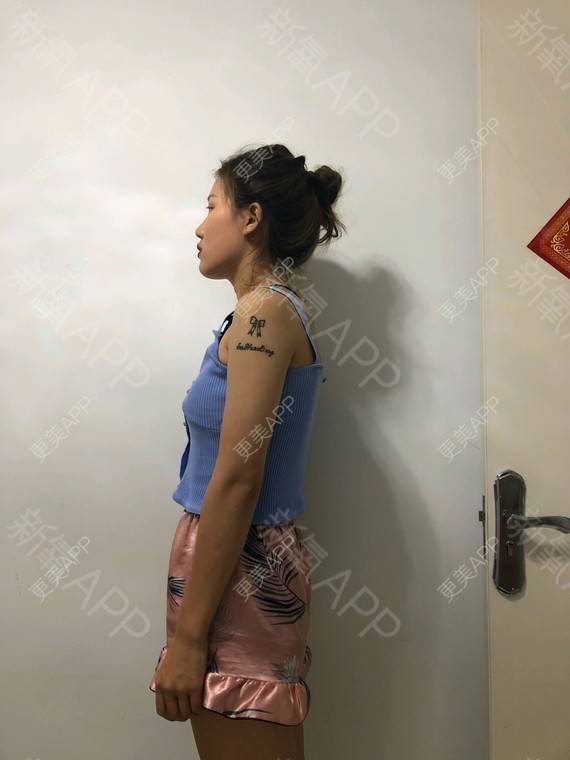 更美 - 更美用户K7KivCJ4C8的自体脂肪丰臀经验 | 自体脂肪丰臀 | 武汉