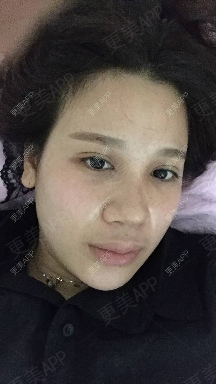 更美 - 更美用户RwtQyrji7u的鼻部多项经验 | 成都 | 鼻部多项